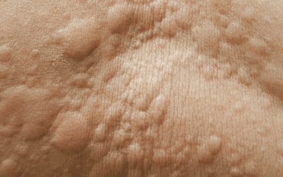 Urticaria
